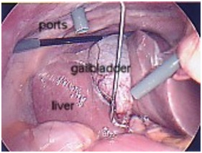 Cholecystectomy Gall Bladder Removal Surgery offers info on Laparoscopic Cholecystectomy India, Gall Bladder Removal Surgery India