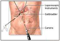 Cholecystectomy Gall Bladder Removal Surgery offers info on Laparoscopic Cholecystectomy India, Gall Bladder Removal India