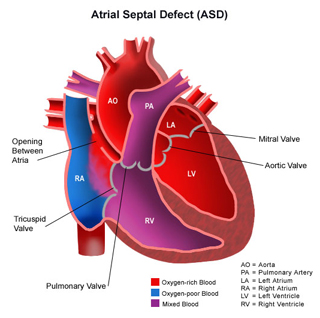 Atrial Septal Defect Surgery India, Atrial Septal Defect, ASD, Pediatric, Heart, Septum