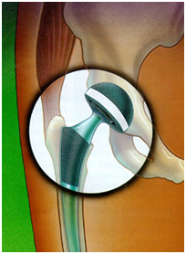 Total Hip Replacement Surgery, Hip Surgery India, Virtual Surgery, Total Hip Replacement