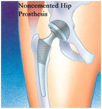 Total Hip Replacement Surgery, Hip Replacement Surgery, Exercises, Operation