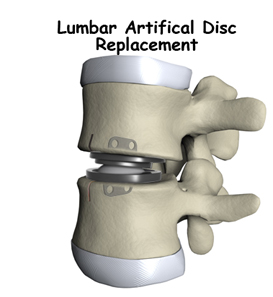Artificial Lumbar Disc Replacement