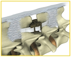 DIAM Spinal Stabilization Surgery, Dentistry, DIAM, Device For Intervertebral Assisted Motion, Lumbar Spine