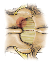 Lumbar Discectomy, Minimally Invasive Spine Surgery, Laminotomy India, Medications India