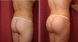 Buttock Enhancement Surgery