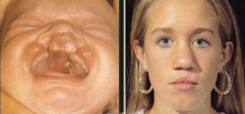 cleft surgery