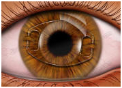 Intraocular Lens Implant, India Intraocular Lenses, Intraocular Lenses