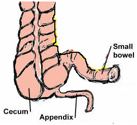 Appendix India, Appendectomy offers info on Appendectomy Appendix Surgery India, Appendix Removal India, Laparoscopic Appendectomy India