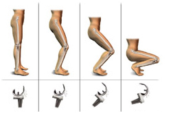 High Flex Knee Replacement, High Flex Knee Replacement Procedurea
