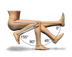 High Flex Knee Replacement Procedure, High Flex TKR, Flexible, High Flex, High Flexion