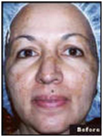 Laser Surgery India Skin Age Spot Removal offers info on India Age Spot Removal India