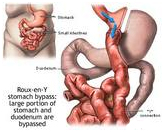 Gastric Bypass Surgery offers info on Bypass Surgery India, Gastric Bypass India, Minimally Invasive Gastric Bypass Surgery India