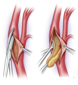 Carotid Artery Disease offers info on Carotid Artery Stenosis India, Atherosclerosis India