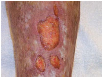 Leg Ulcers Associated With Sideroblastic Anemia India, Medical Publishers India