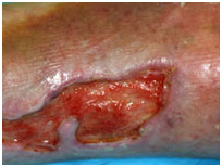 Lower Leg Ulcers Treatment India offers info on Cost Leg Ulceration - Ethnicity India, Medical Publishers India, Scientific Publishers India