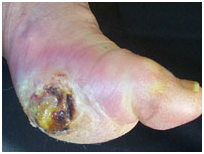 Leg Ulcers Associated With Sideroblastic Anemia India, Scientific Publishers India, Wound India