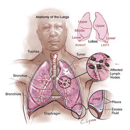 Lung Cancer Symptoms India, Lung Cancer Information India, Cancer India, Research India