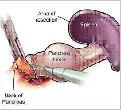 Pancreatic Cancer Treatment India, Pancreatic Cancer Research India, Symptoms India, Pancreatic Cancer Treatment India