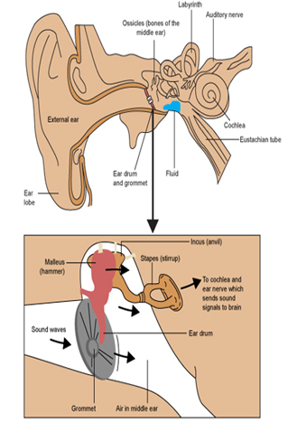 Insertion Of Grommets Fact Sheet Children's Health Queensland