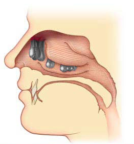 nasal polypectomy procedure