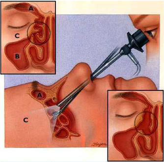 Nasal Polyp Removal, Nasal Polyp Removal Risk, Benefits Nasal Polyp Removal, Symptoms Of Nasal Polyp Removal