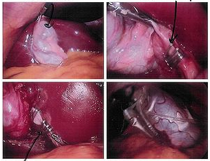 Cholecystectomy Gall Bladder Removal Surgery offers info on Laparoscopic Cholecystectomy India