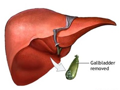 Cholecystectomy Gall Bladder Removal Surgery offers info on Laparoscopic Cholecystectomy India, Gall Bladder Removal India, Gall Bladder India