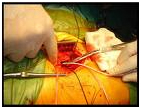 Femoral Embolectomy Surgery offers info on Femoral Embolectomy India, Femoral Embolectomy India