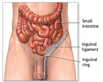Hernia Repair Inguinal Surgery offers info on India Affordable Hernia Repair Inguinal India