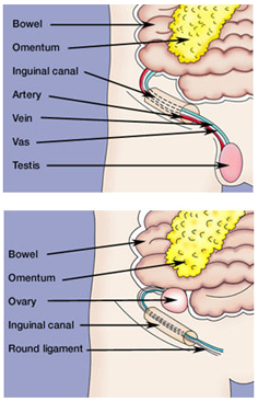 Hernia Repair India, Hernia Repair Inguinal Surgery India