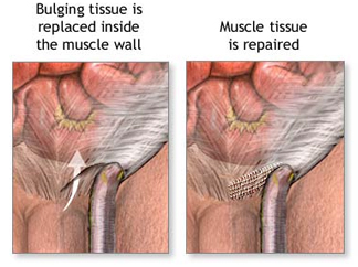 Hernia Repair Inguinal Surgery offers info on India Affordable Hernia Repair Inguinal India, Hernia Repair India