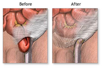Hernia Repair Inguinal Surgery offers info on India Affordable Hernia Repair Inguinal India, Affordable Hernia Repair Inguinal Surgery India