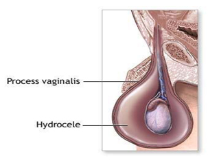 Hydrocele Surgery India, Hydrocele offers info on Adult Onset Hydrocele India