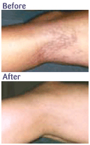 Varicose Vein Removal Surgery offers info on Varicose Vein Removal India, Vein India, Veins India, Veins Surgery India, Varicose Vein Removal Surgery India