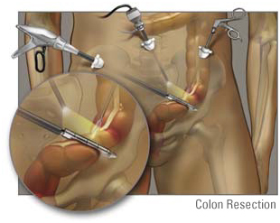 Colorectal Surgery offers info on Colorectal India, Colorectal Surgery India, Colorectal Surgery Information India