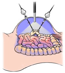 Colorectal Surgery offers info on Colorectal India, Colorectal Surgery India, Colorectal Surgery Information India