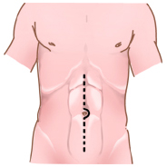Colorectal Surgery Information India, Colon And Rectal Surgeons India, Crohns Disease India