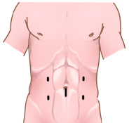 Colorectal Surgery India, Colorectal Surgery Information India, Colon And Rectal Surgeons India