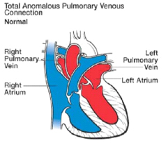 Total Anomalous Pulmonary Venous Connection, TAPVC, Pediatric Surgery India, TAPVC, Total Anomalous Pulmonary Venous Drainage