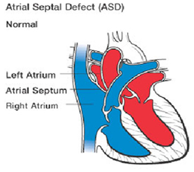 Atrial Septal Asd Surgery, Atrial Septal Asd India