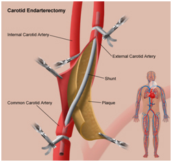 Vascular Surgeon, Carotid Artery Disease, Stroke, Carotid Artery