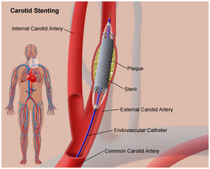 Vascular Surgeon, Carotid Artery Disease,  High Blood Pressure, India Hopsial Tour