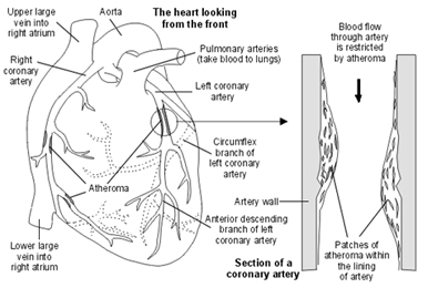 Coronary Angiography, Coronary Angiogram India