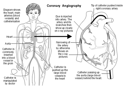 Coronary Angiogram India, Affordable Coronary Angiography