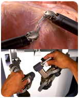 Da Vinci Robotic Surgery, Heart Surgery India, Diseases And Conditions, Robotic Heart Surgery, Critical Care Medicine