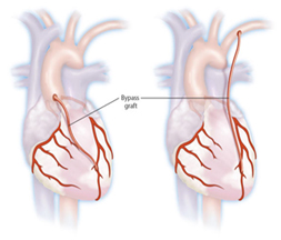 Heart Surgery, India Cabg Surgery, Beating Heart Surgery