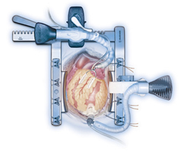 Off Pump Beating Surgery, India Cabg Surgery, Off-Pump Heart Bypass Surgery