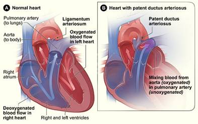 Pda Closure Pda Closure Surgery India India Pda Heart Surgery Cost