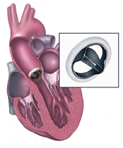 PAortic Valve Surgery India,, Stenosis, Aortic Valve Disease