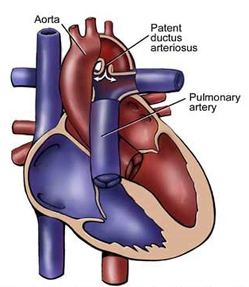 Pediatric Surgery, Patent Ductus Arteriosus India, Patent Ductus Arteriosus Treatment